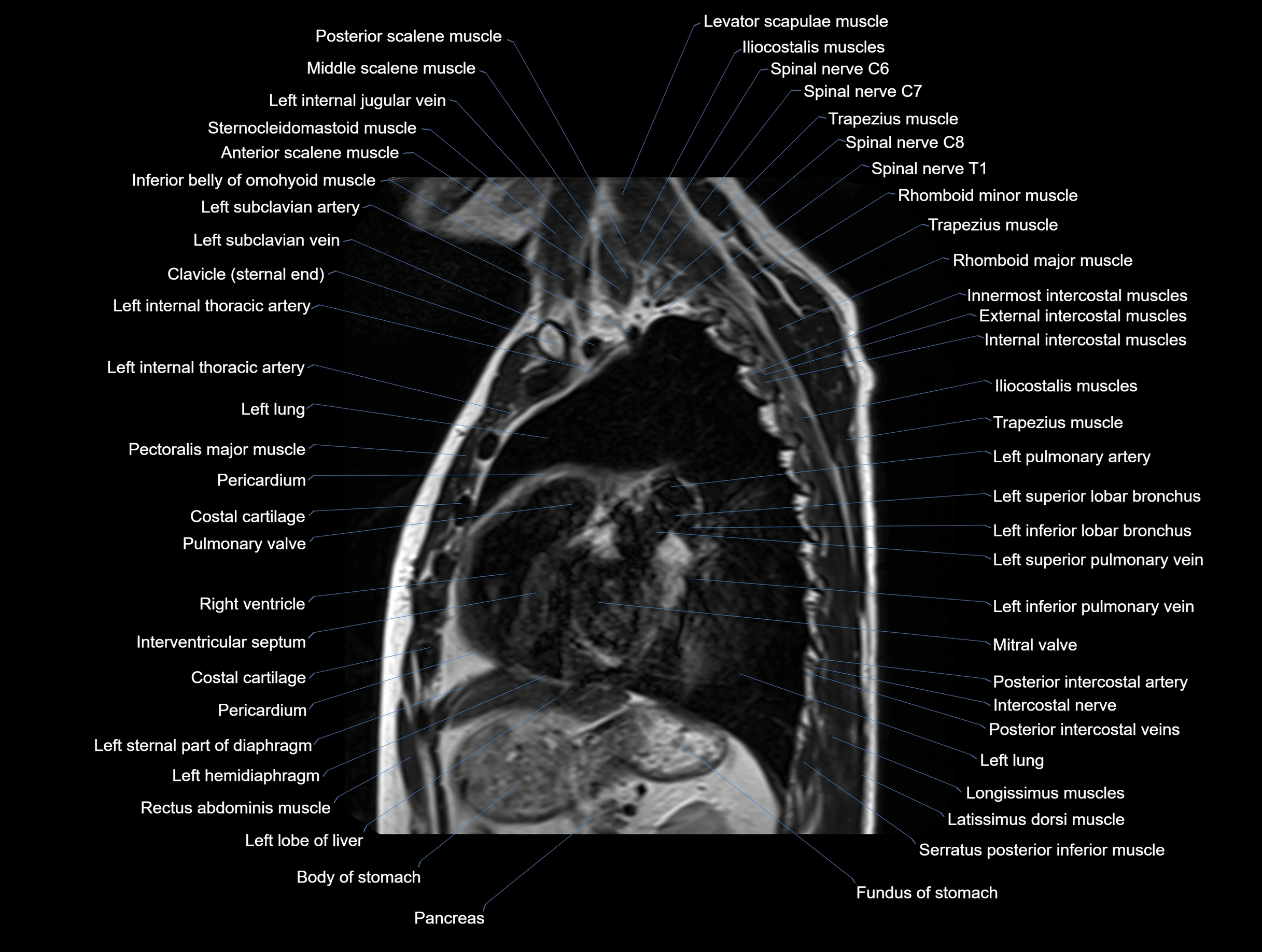 MRI chest (thorax) coronal  cross sectional anatomy 3T radiology  image-img-00001-00024.webp